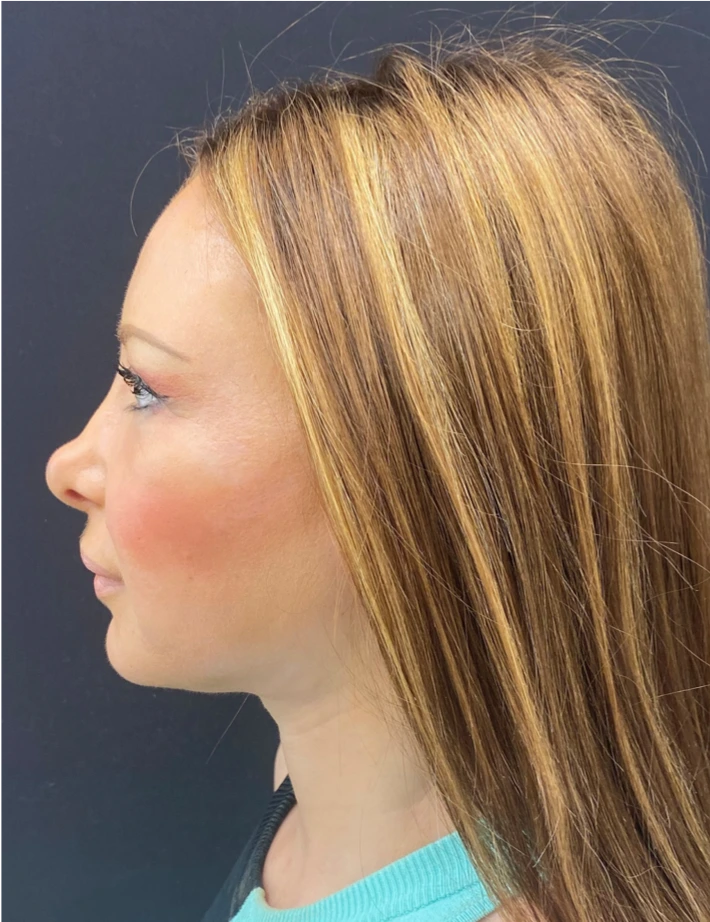 Facelift-and-Facial-Fat-Grafting-Case--1679 | After Face 2