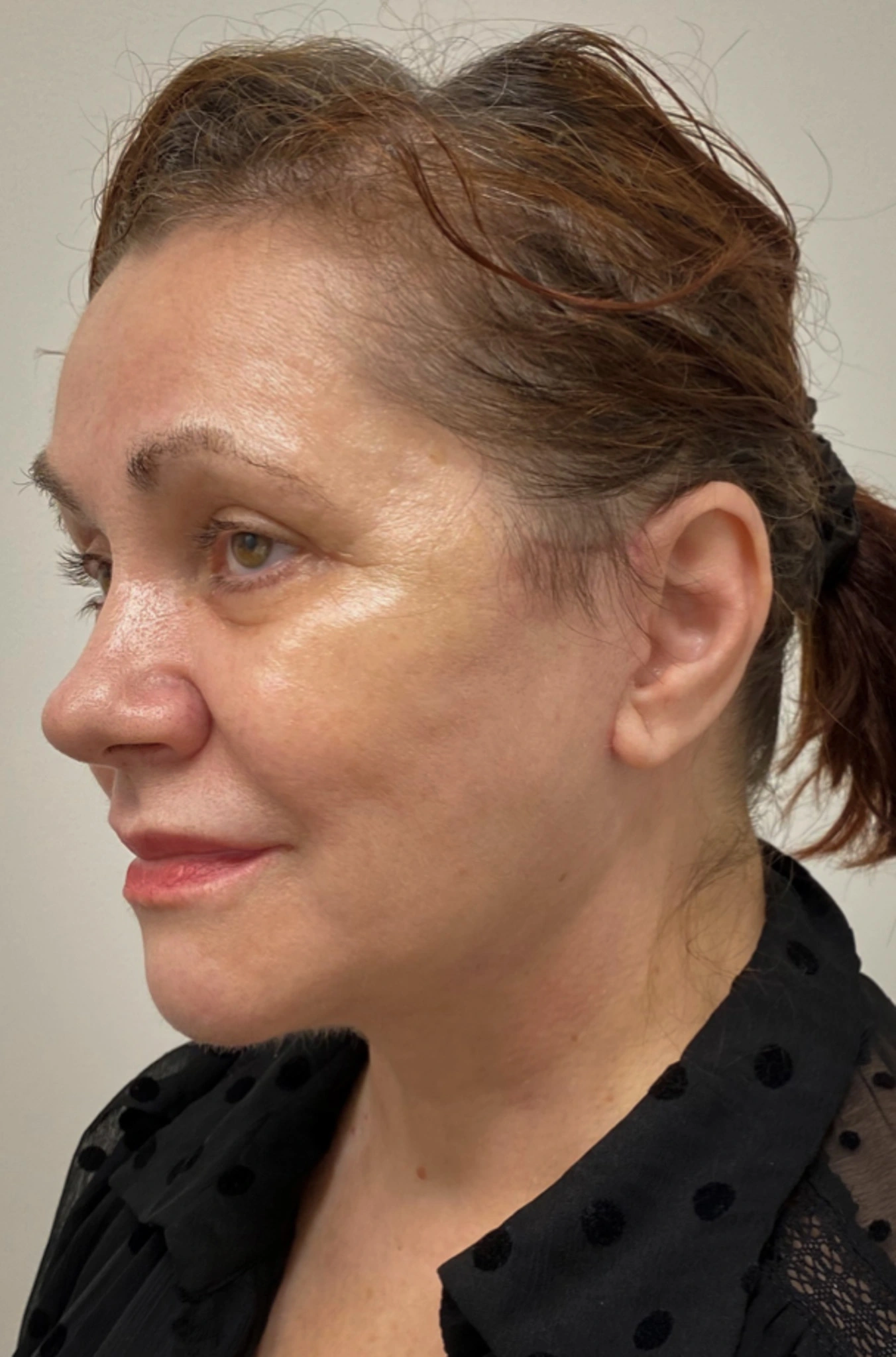 Necklift-Case--1496 | After Neck Lift 4