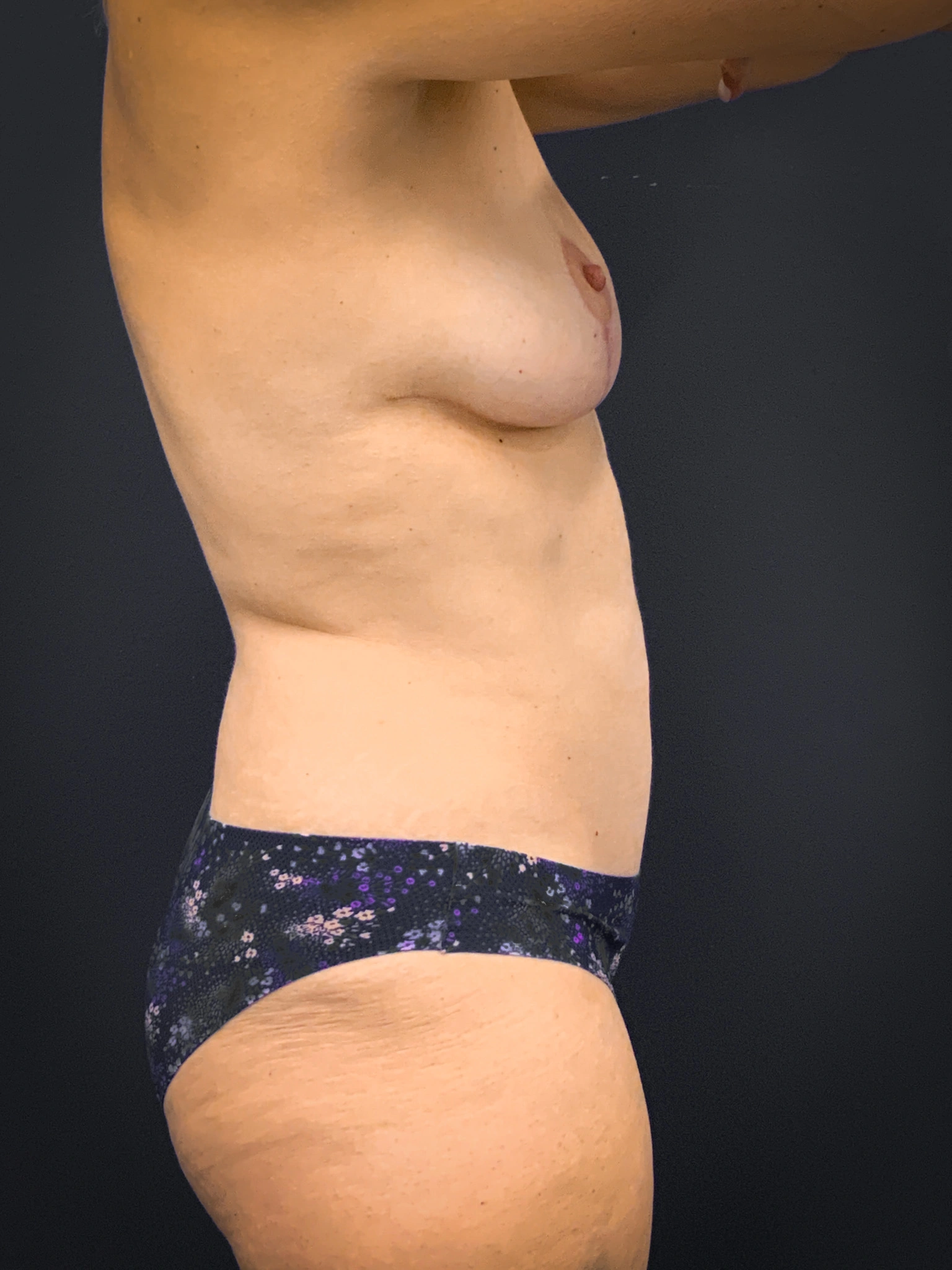 Breast-Augmentation-Case--1469 | After Breast Augmentation 2
