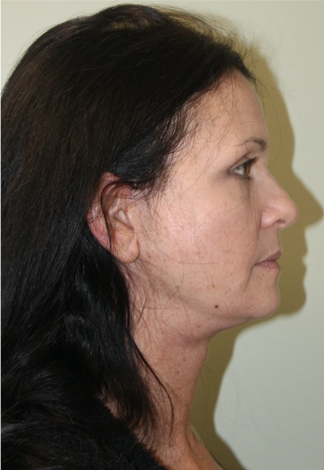 Face-and-Neck-Lift-Case--9403 | After Facelift 2