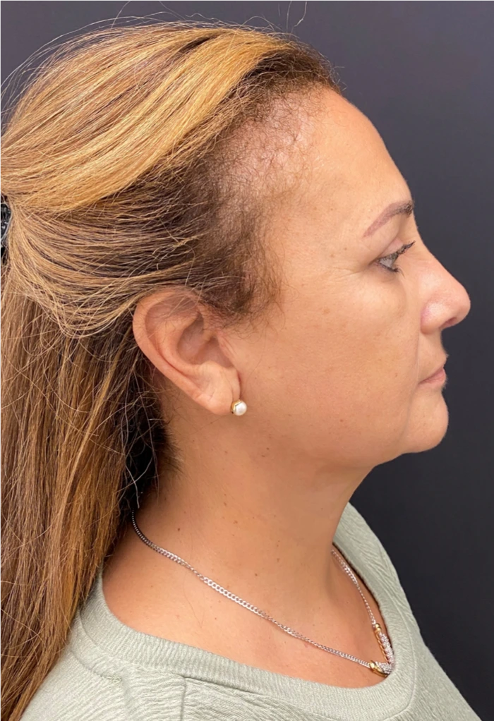 Necklift-Case--4869 | After Neck Lift 2