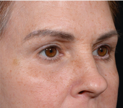 Quad-Blepheroplasty-Case--5361 | After Eyelid Surgery 2