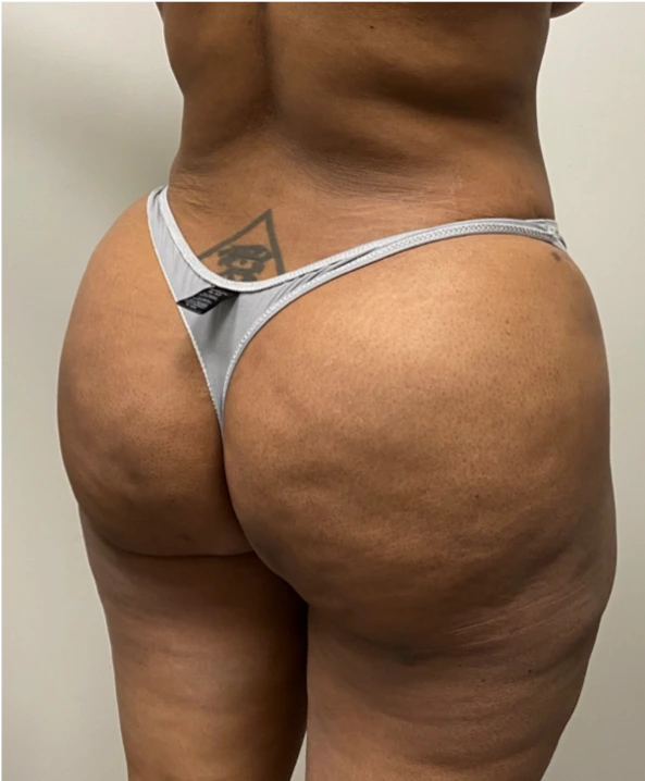 Brazilian-Butt-Lift-Case--7979 | After Dr. Arjun Kanuri 2