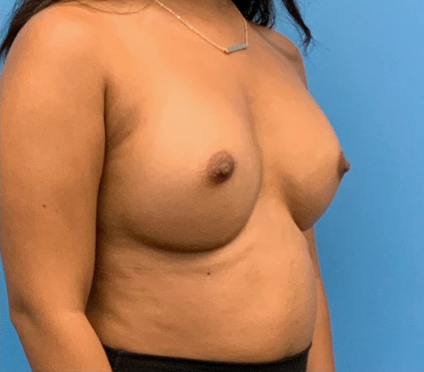 Breast-Augmentation-Case--1115 | After Breast Augmentation 5