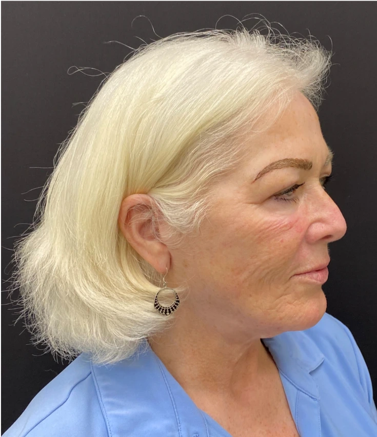 Face-and-Neck-Case--1975 | After Facelift 2