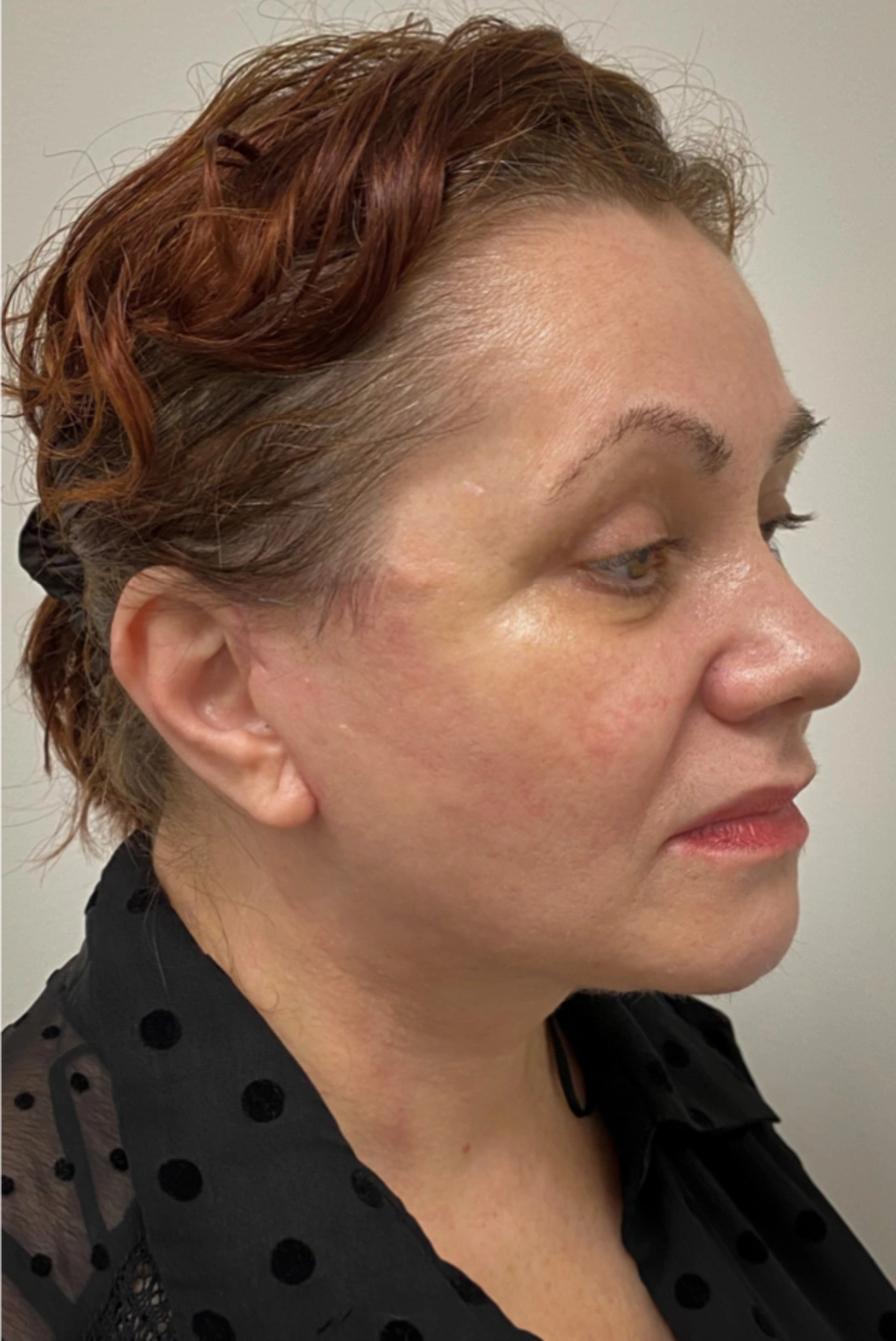 Necklift-Case--1496 | After Neck Lift 3