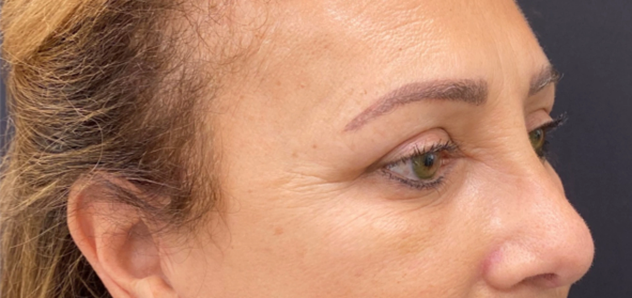 Brow-Lift-Case--6540 | After Brow Lift 3