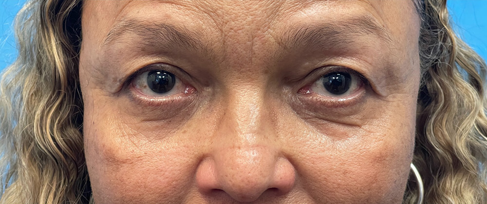 Before upper eyelid surgery