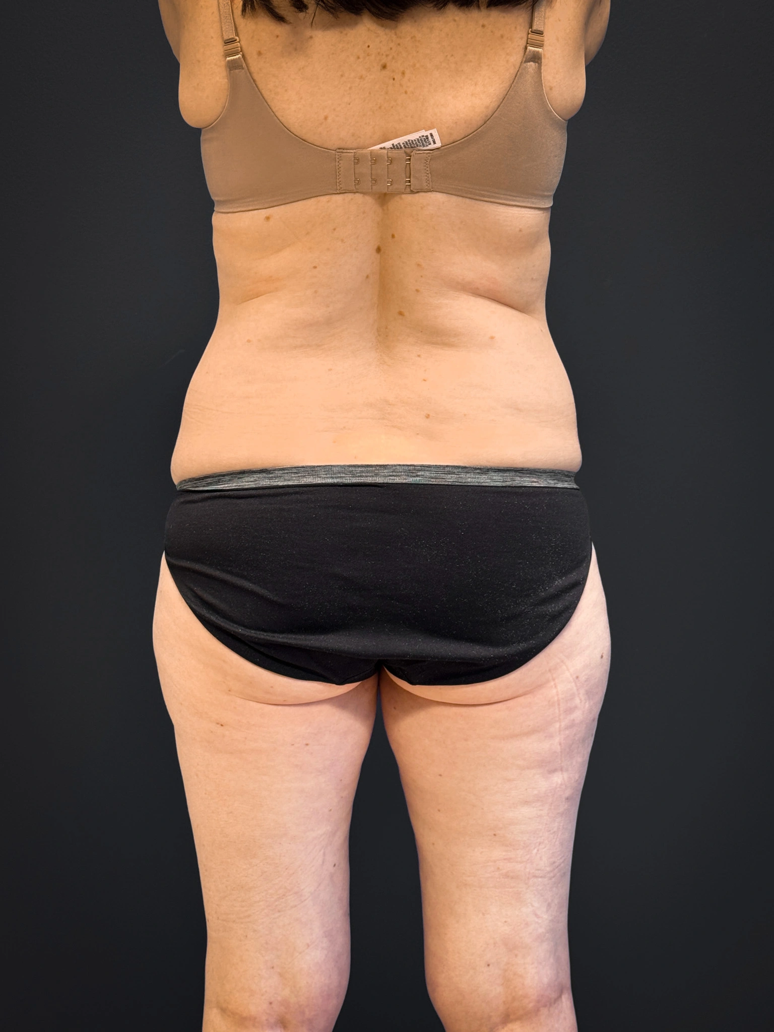 Tummy-Tuck-Case--7170 | Before Tummy Tuck 4