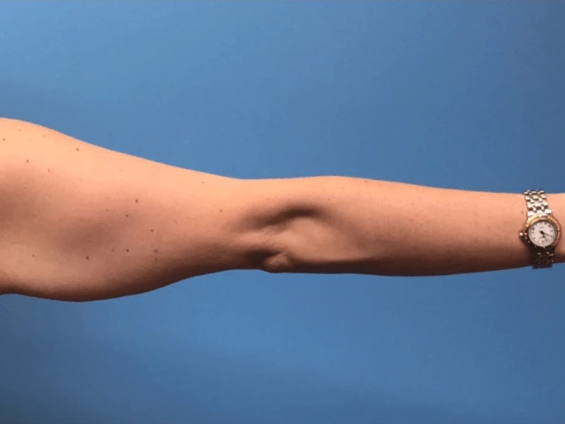 Brachioplasty-Case--276 | Before Body 2
