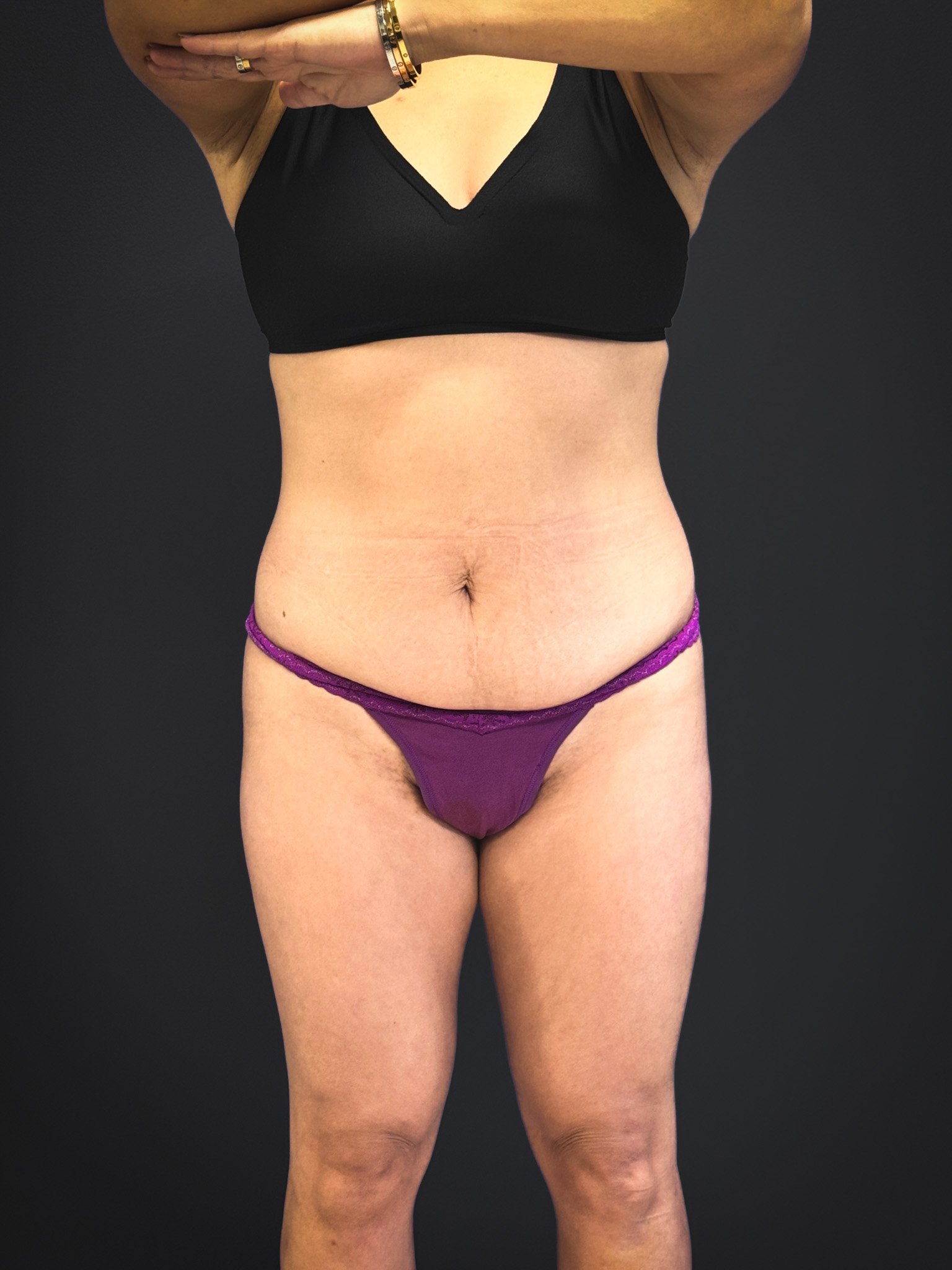 Tummy-Tuck-Case--3757 | Before Dr. Samir Rao 1