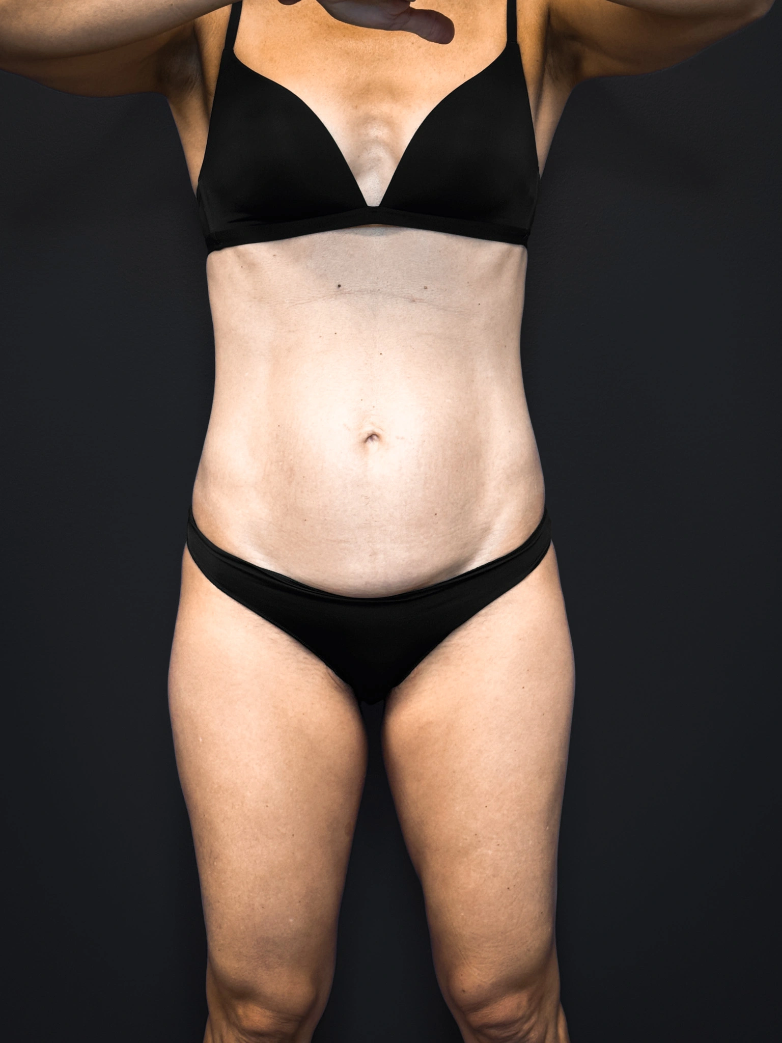 Tummy-Tuck-Case--2729 | Before Body 1
