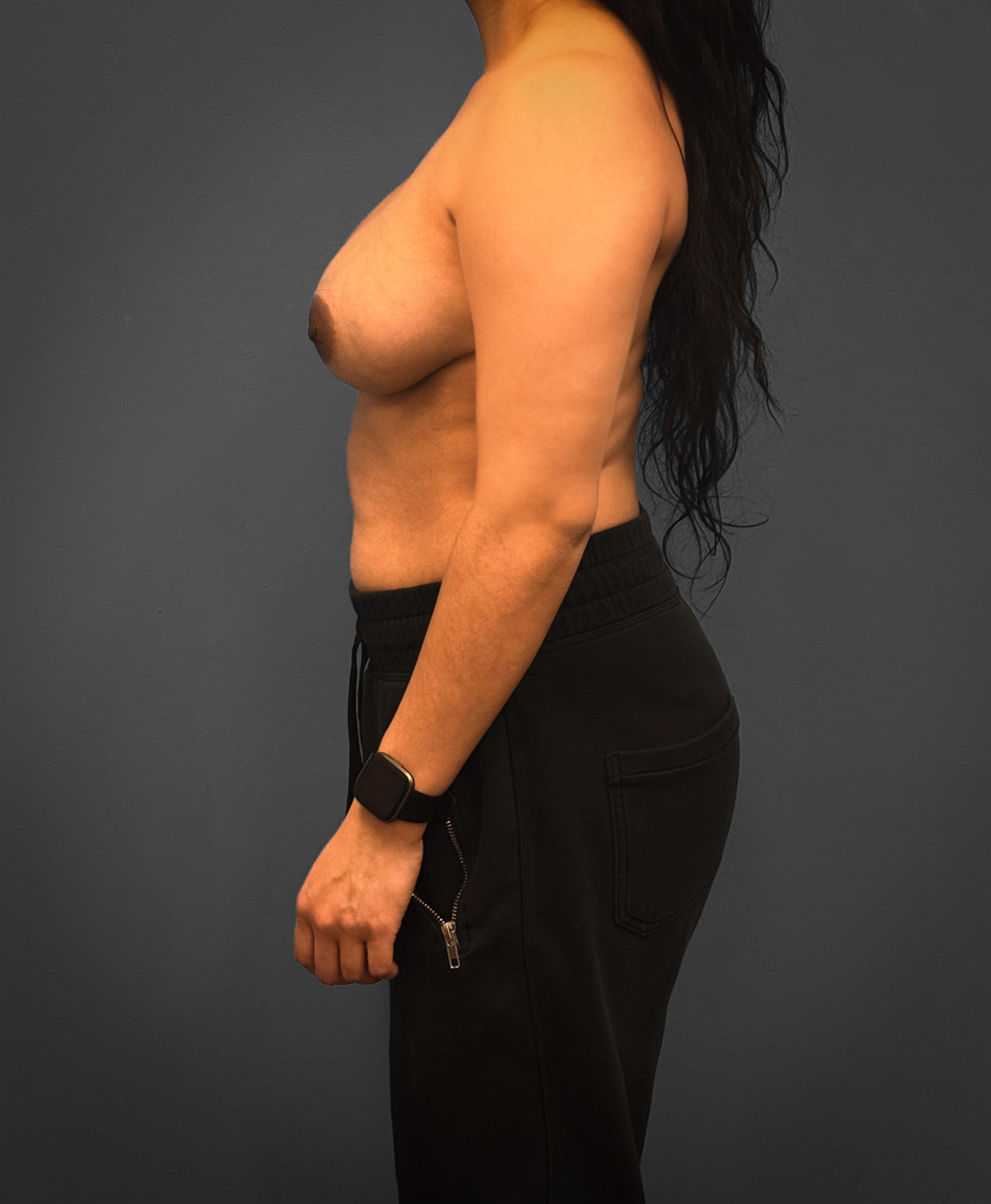 Breast-Reconstruction-Case--7171 | Before Breast Reconstruction 2