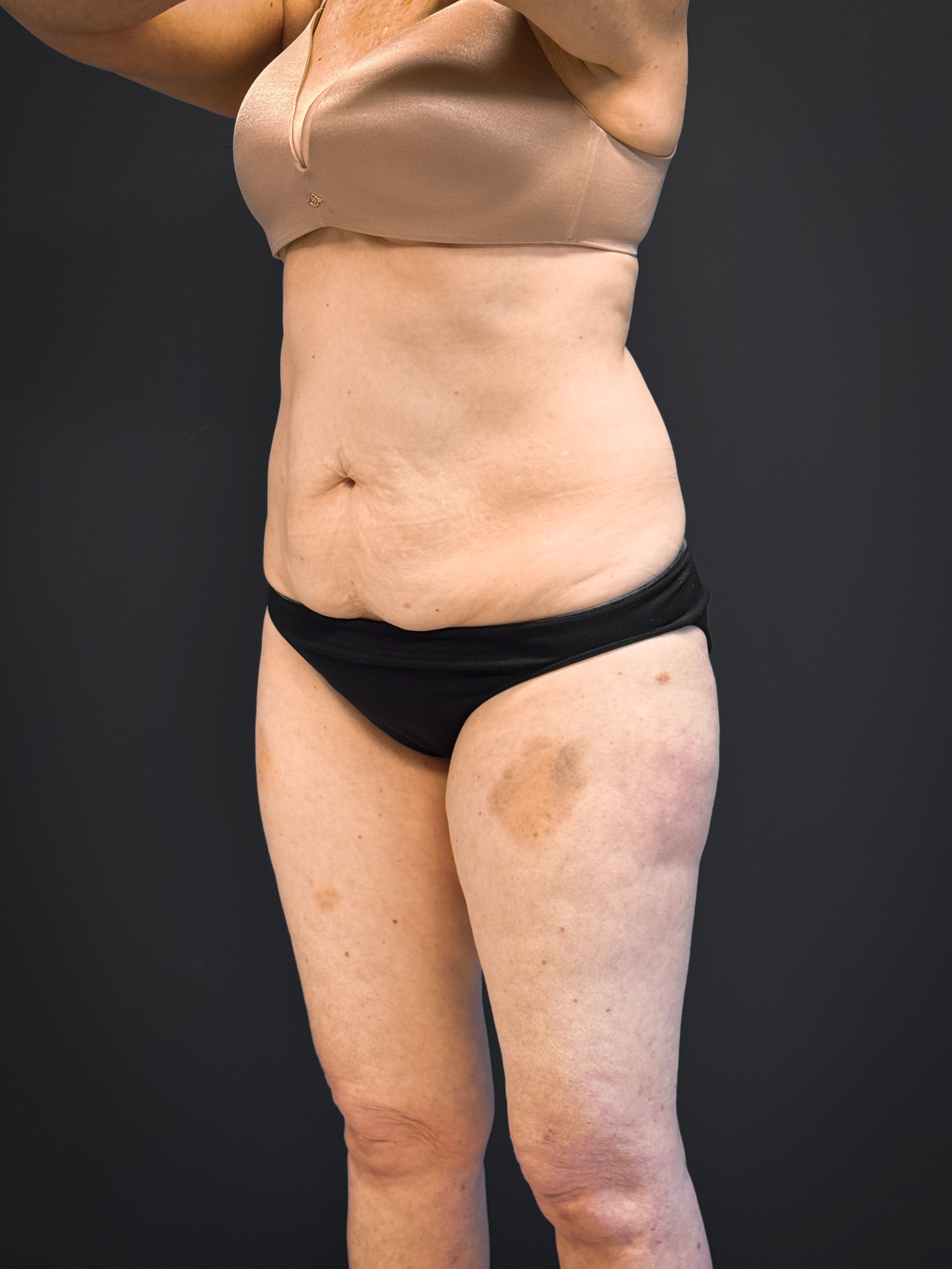Tummy-Tuck-Case--7170 | Before Dr. Samir Rao 2