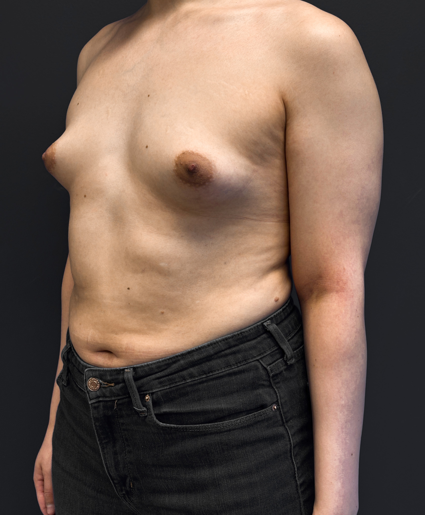Before breast augmentation, left oblique view