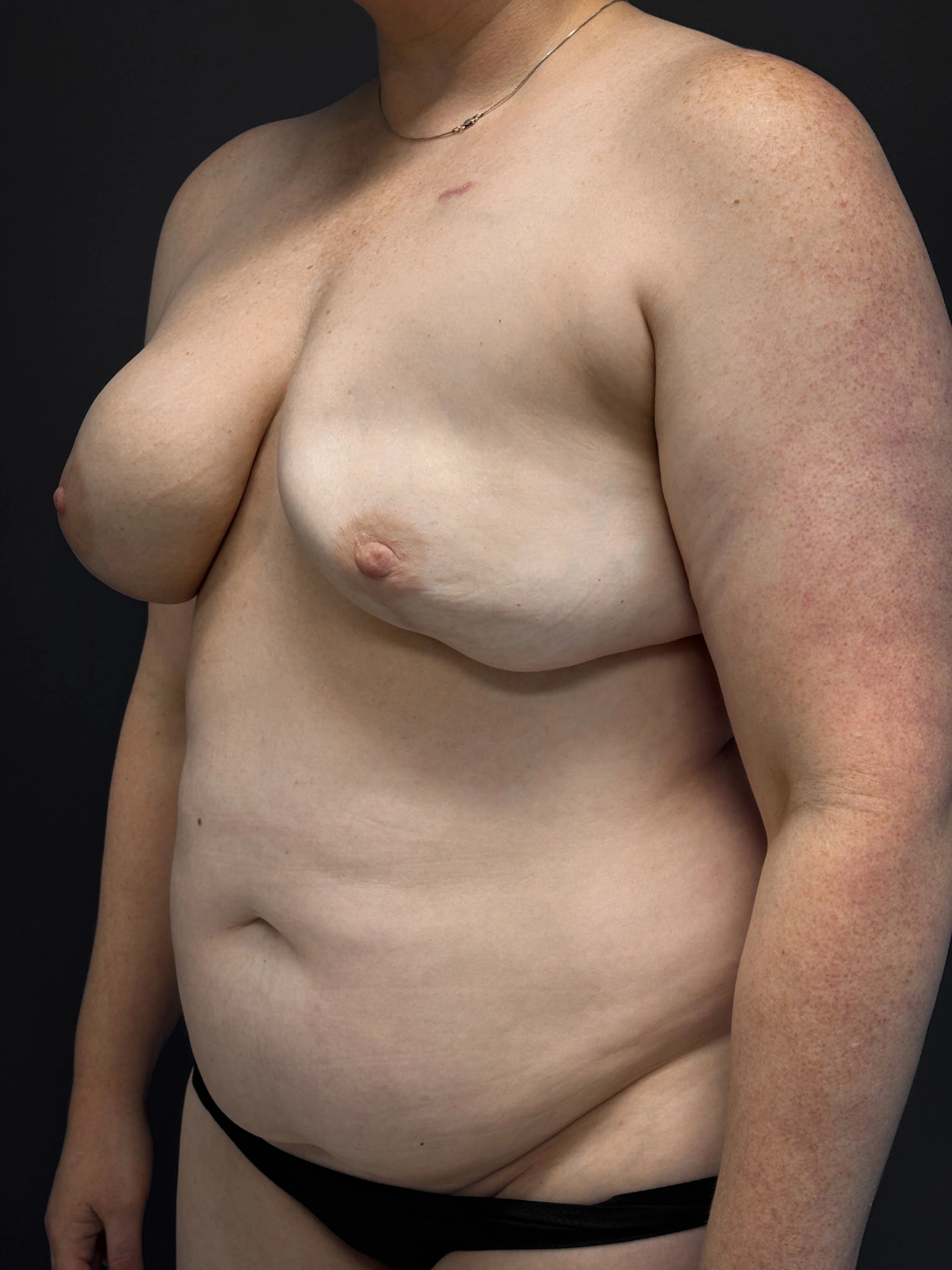 Before DIEP flap breast reconstruction, left oblique view