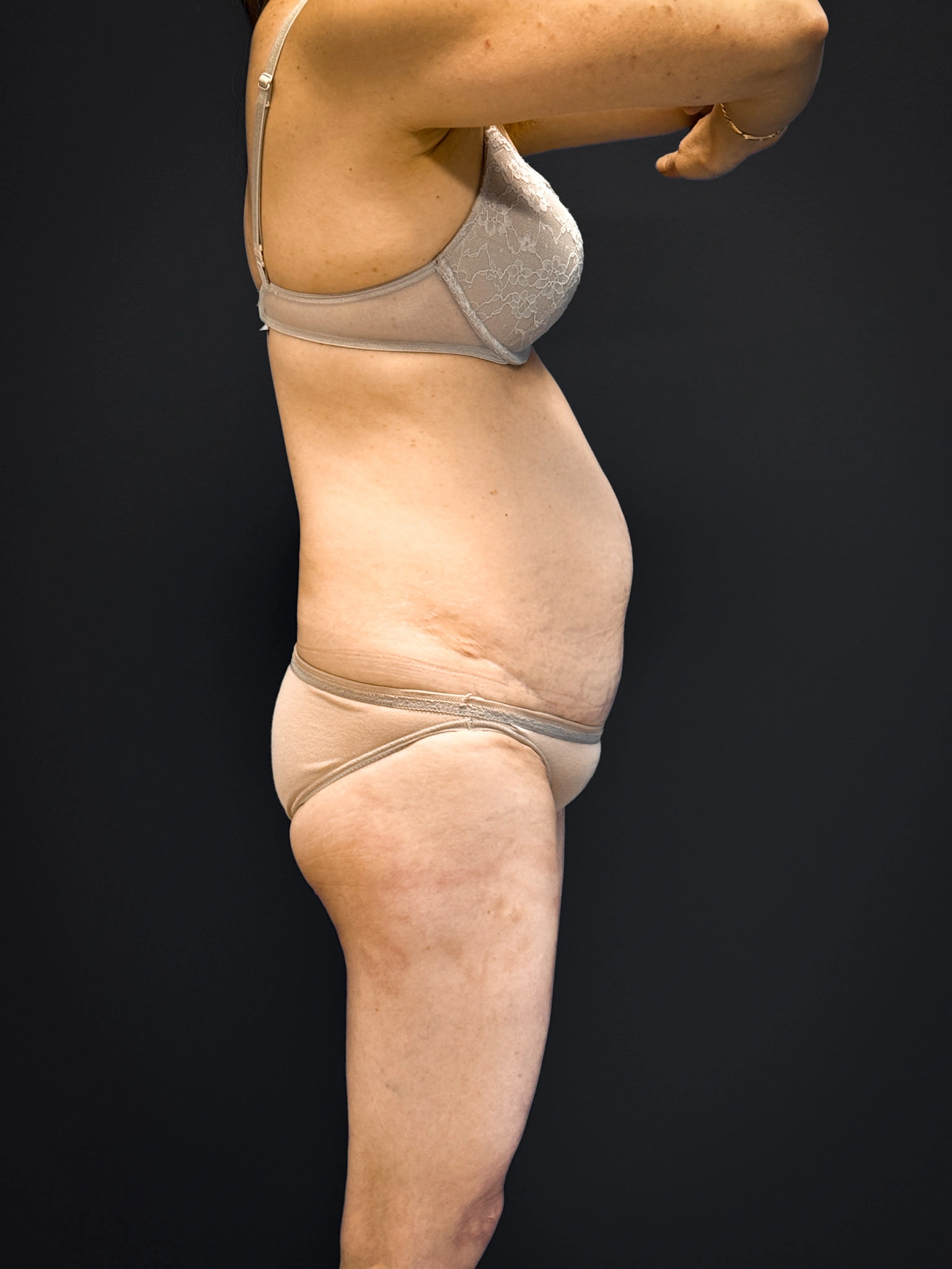 Tummy-Tuck-Case--5969 | Before Dr. Samir Rao 2