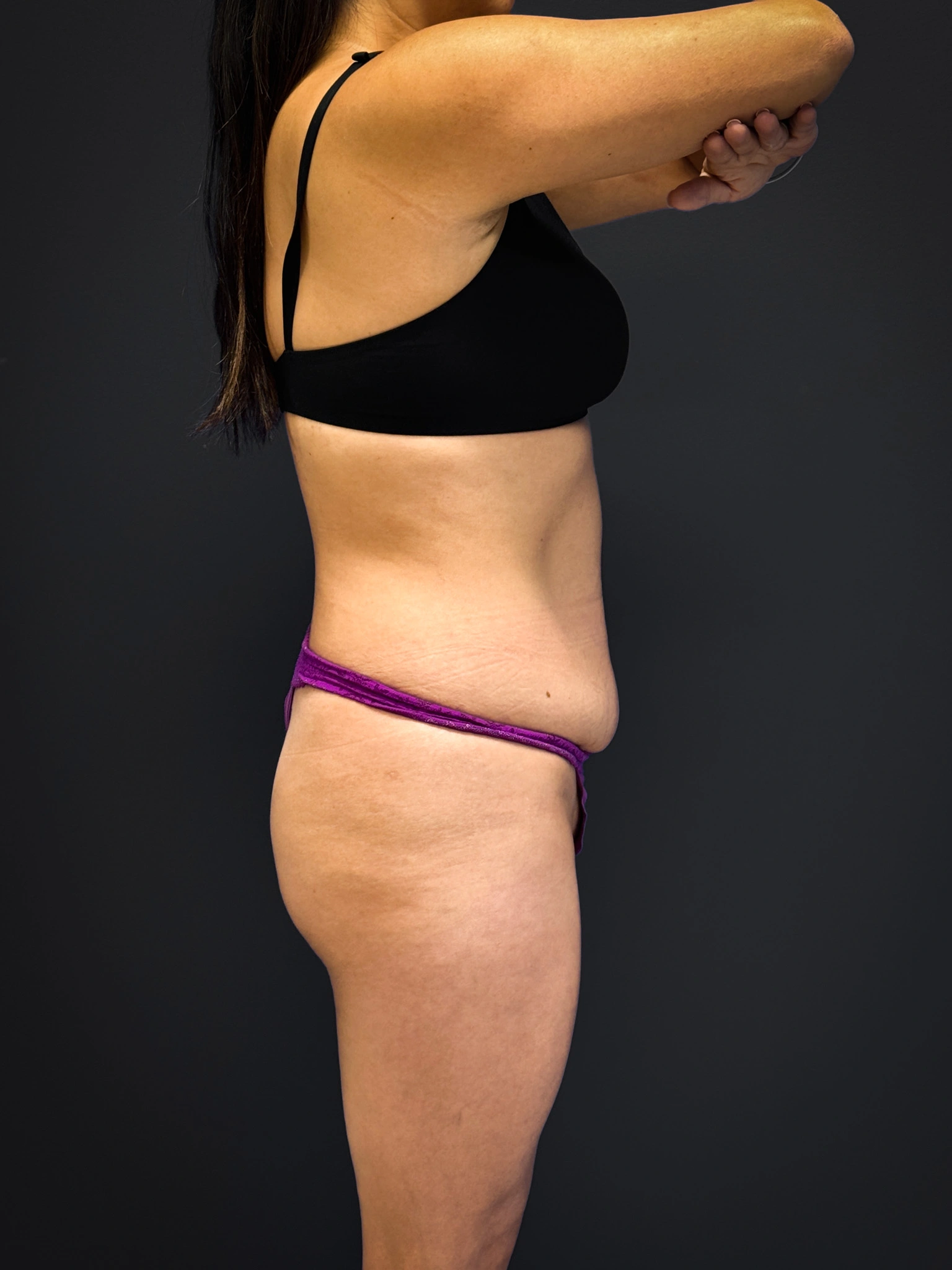 Tummy-Tuck-Case--3757 | Before Dr. Samir Rao 2