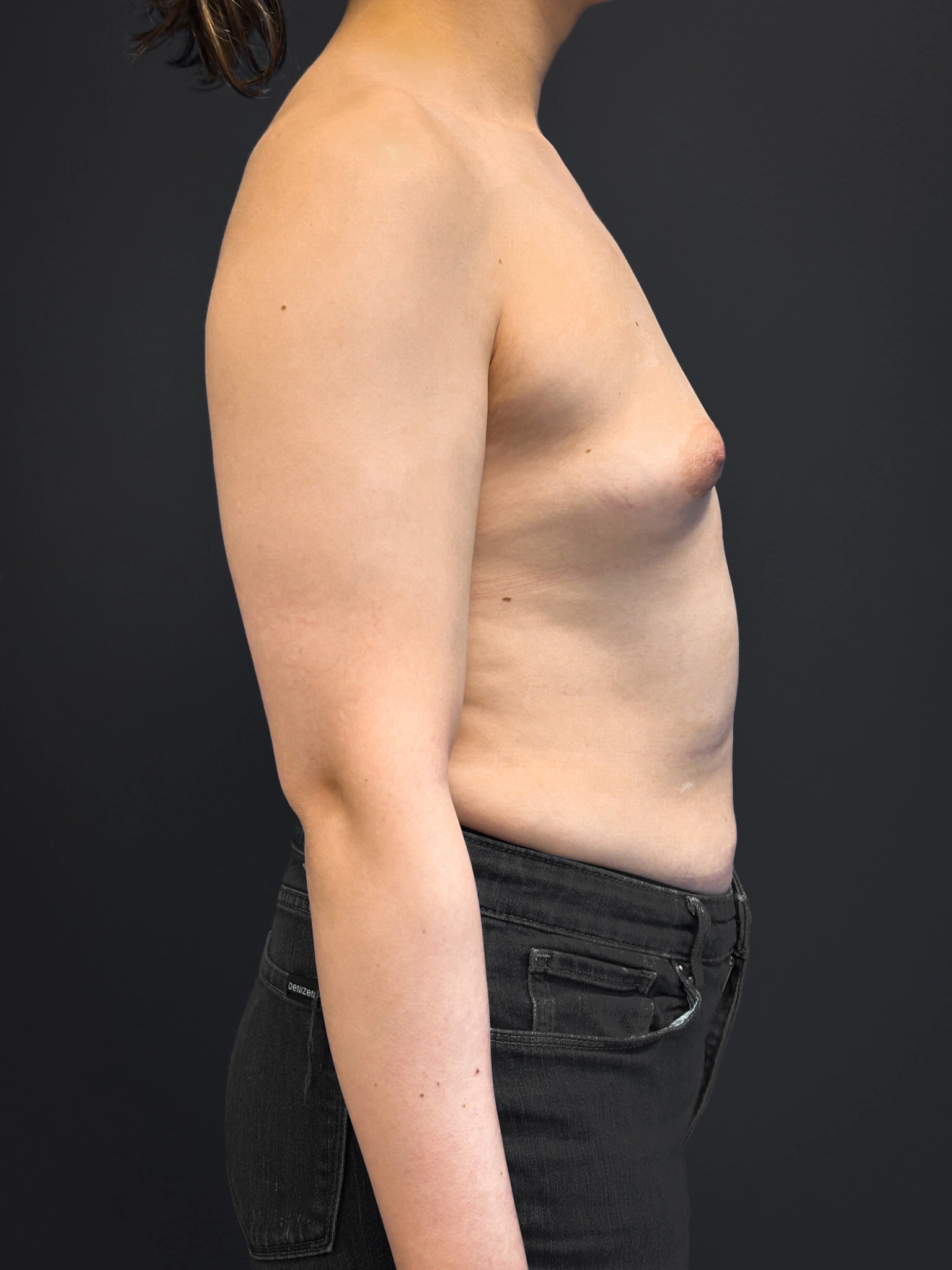 Right profile of patient before undergoing breast augmentation surgery