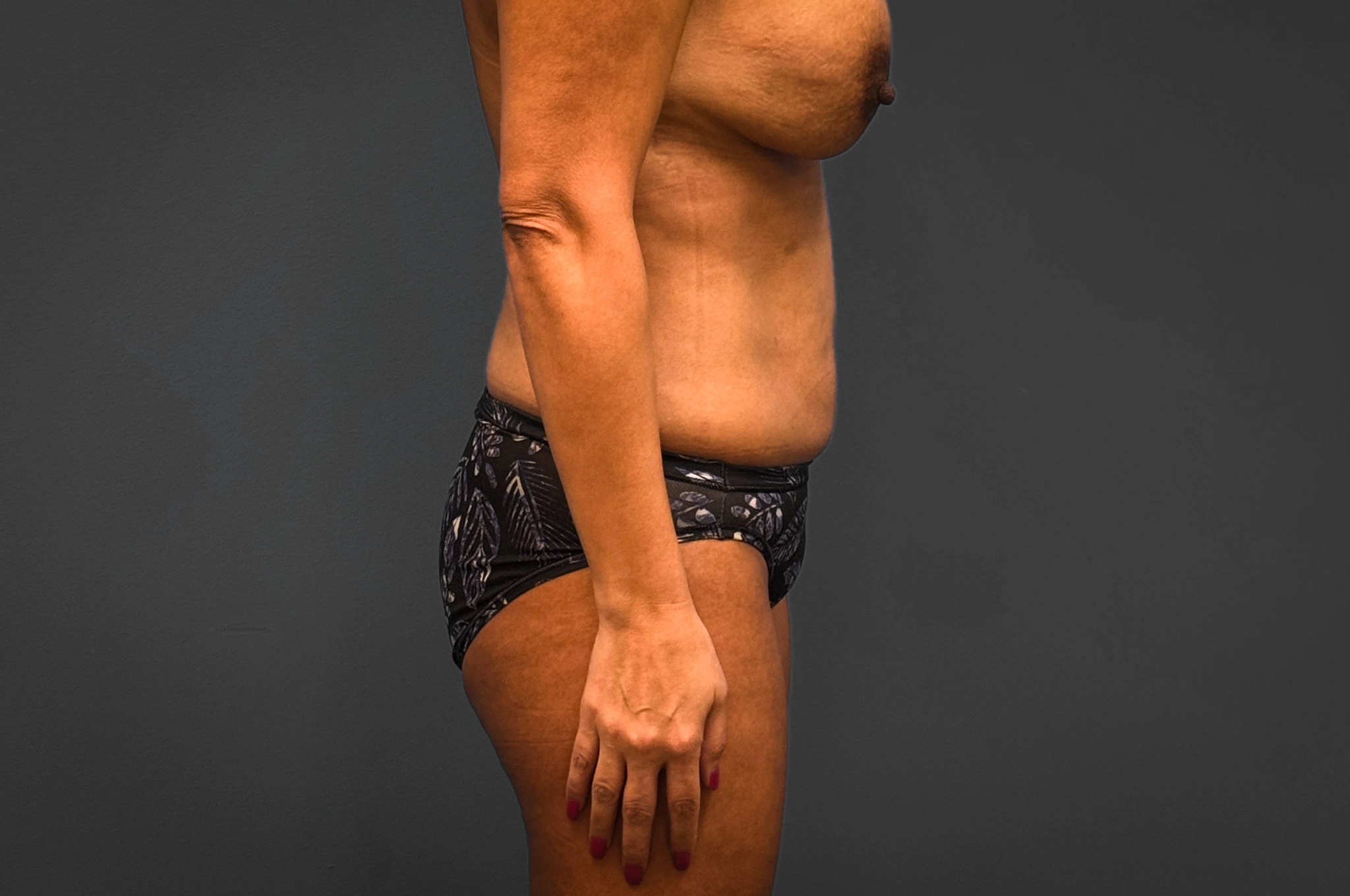 Abdominoplasty-Flank-Liposuction-Case--6263 | Before Body 2