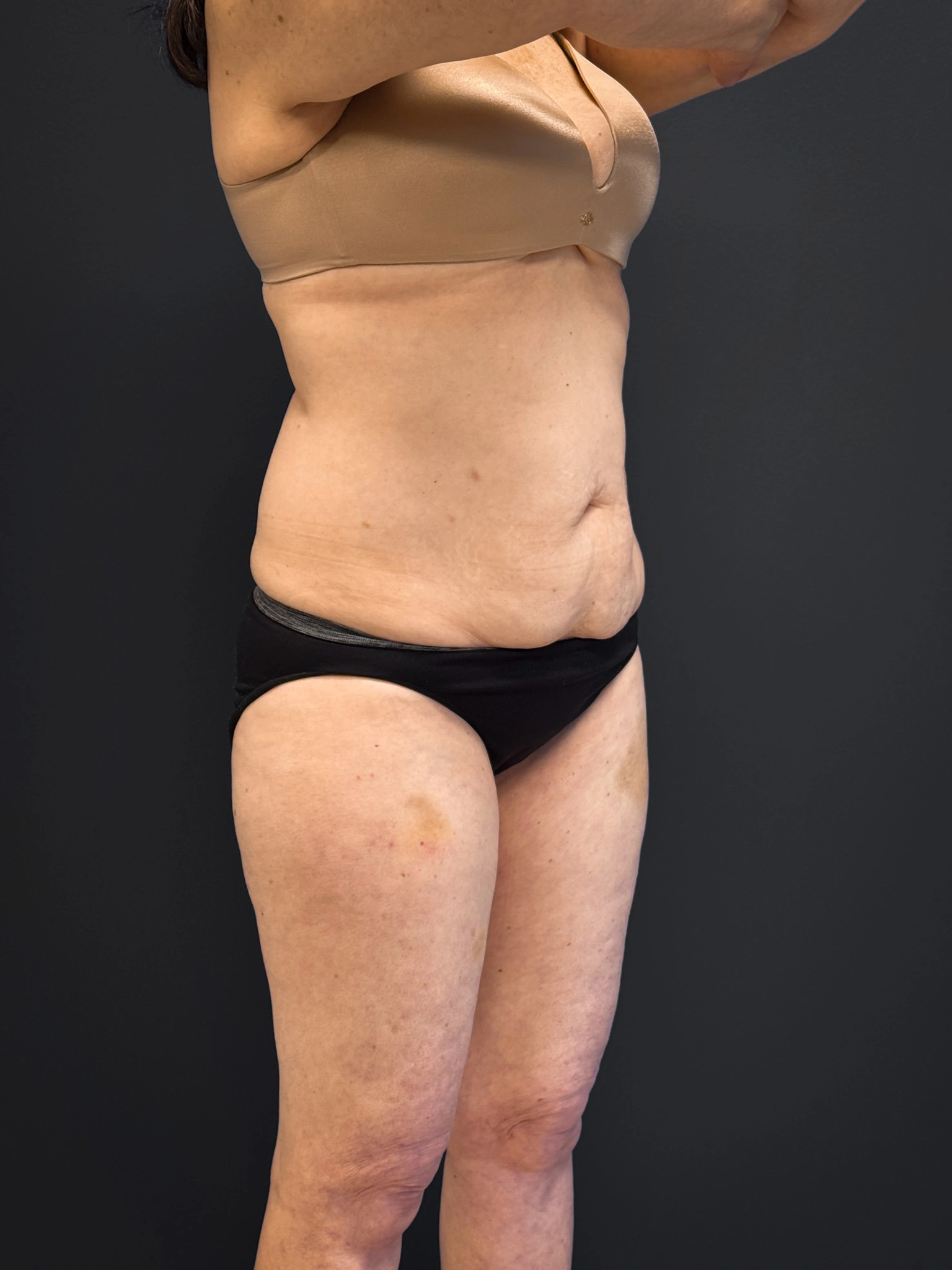 Tummy-Tuck-Case--7170 | Before Tummy Tuck 6