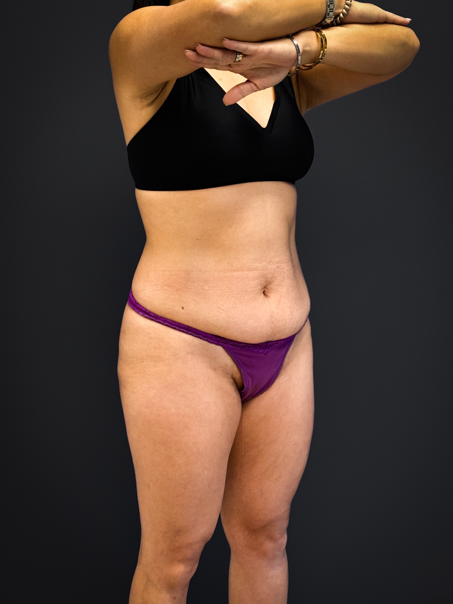 Tummy-Tuck-Case--3757 | Before Tummy Tuck 3