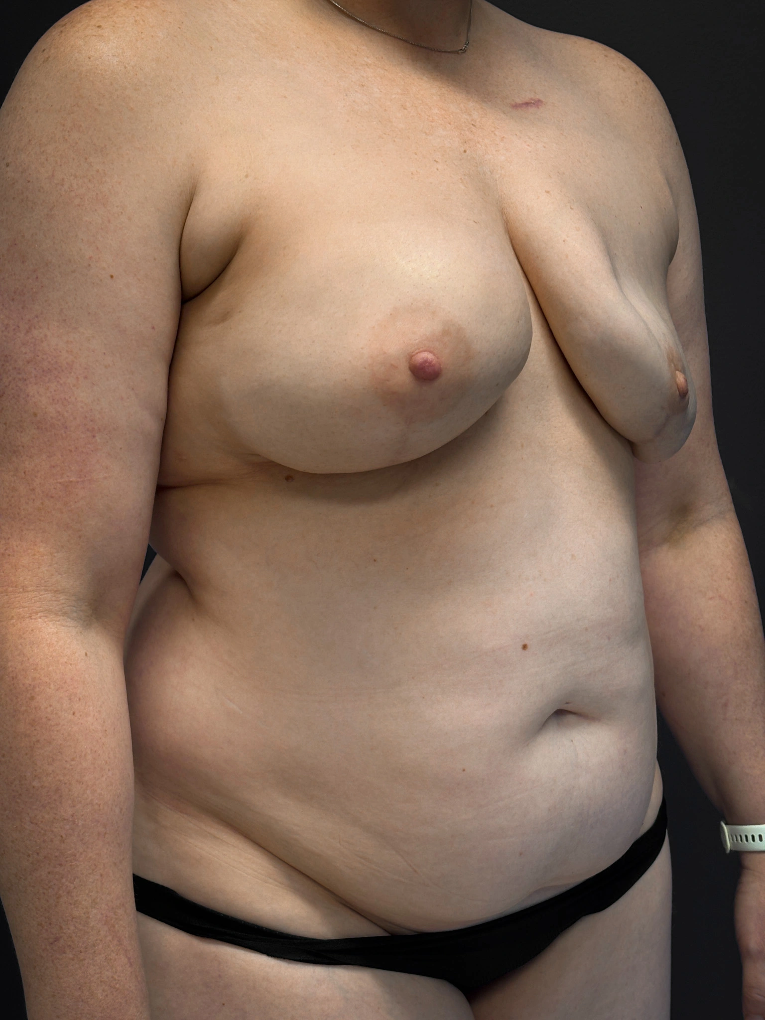 Before DIEP flap breast reconstruction, right oblique view