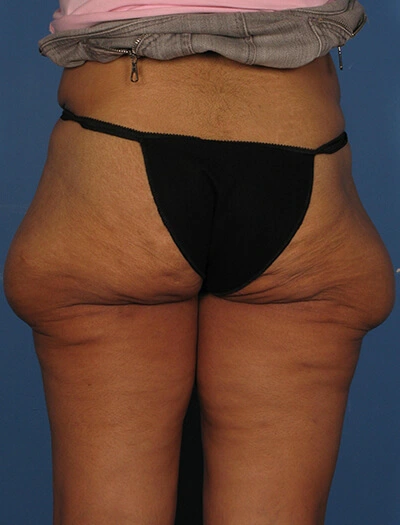 Thigh-lift-Case--75 | Before Body 2