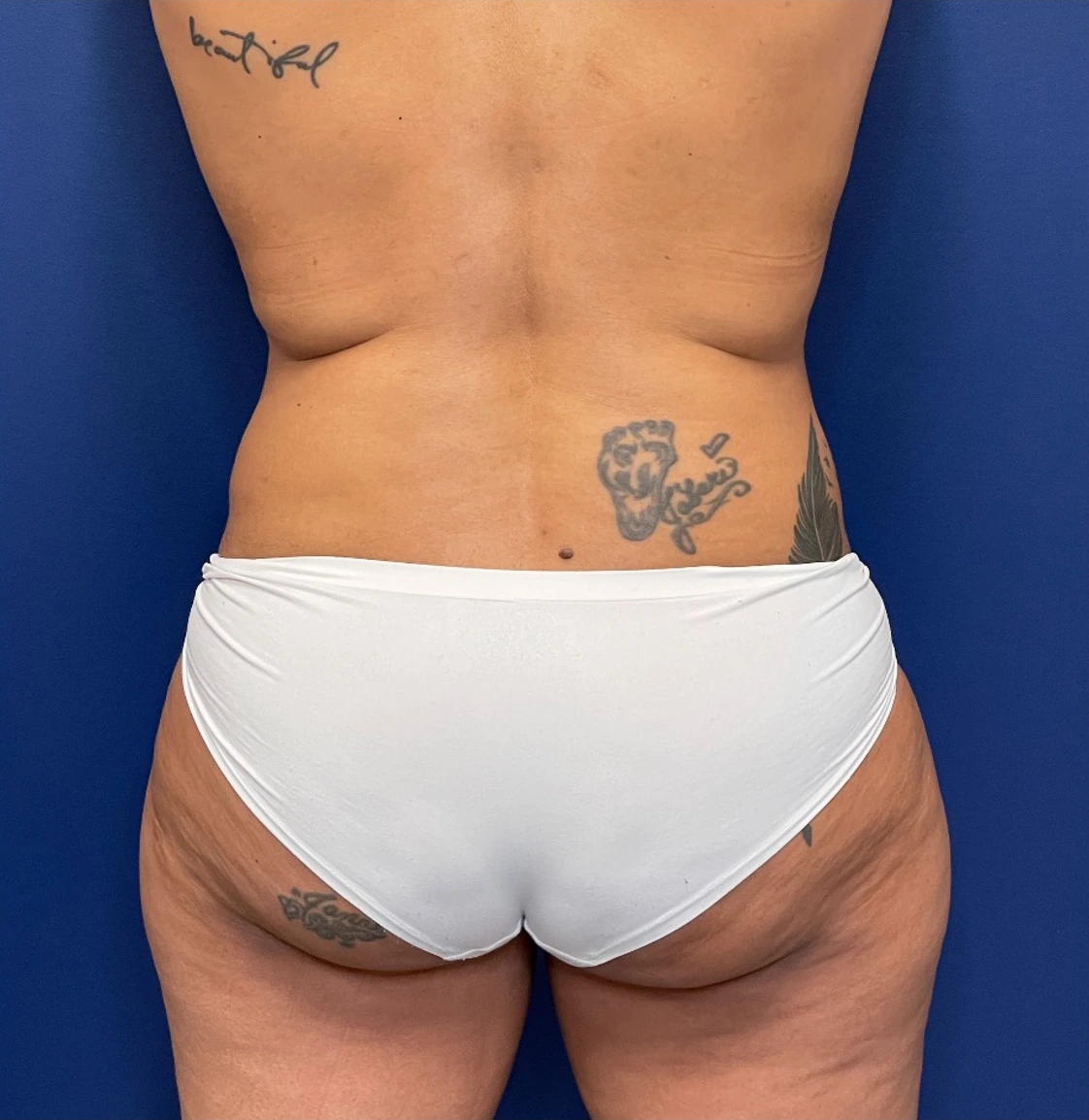 Liposuction-Case--254 | Before Liposuction 3