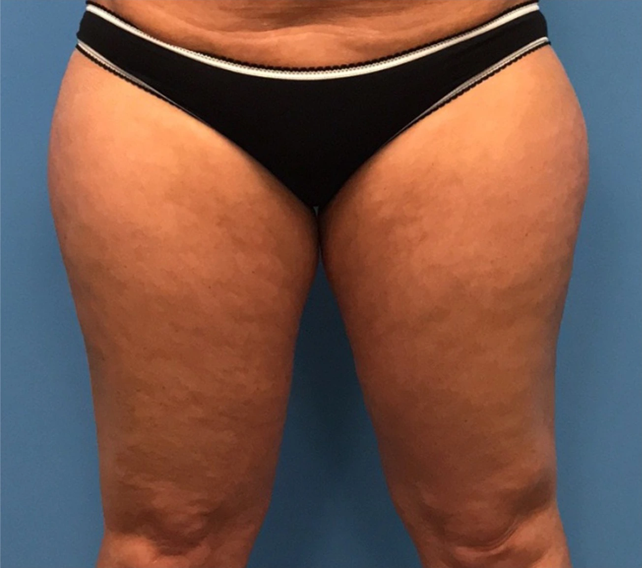 Case--278 | Before Liposuction 1