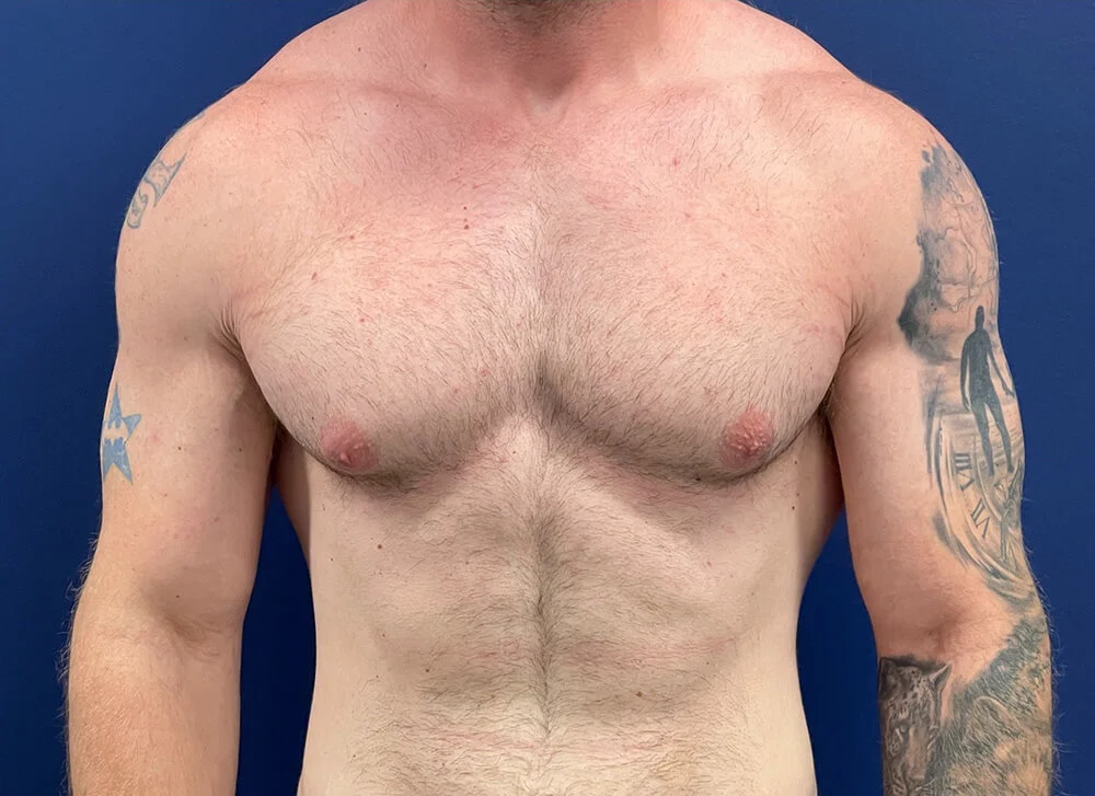 Before gynecomastia surgery, front view