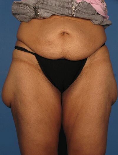 Thigh-lift-Case--75 | Before Body 1