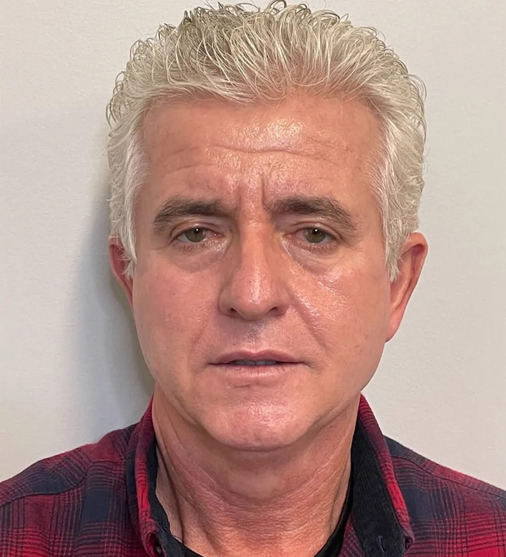 Facelift-Blepharoplasty-Case--291 | Before Dr. Samir Rao 1