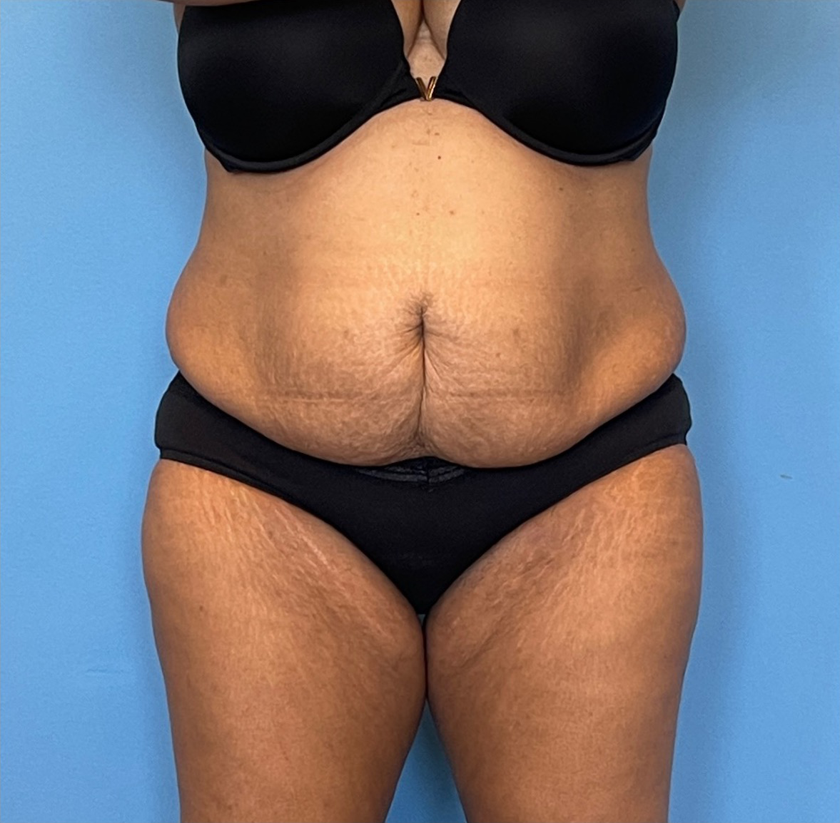 Lipoabdominoplasty-Case--255 | Before Dr. Samir Rao 1