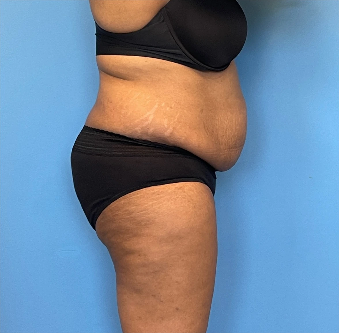 Lipoabdominoplasty-Case--255 | Before Dr. Samir Rao 2