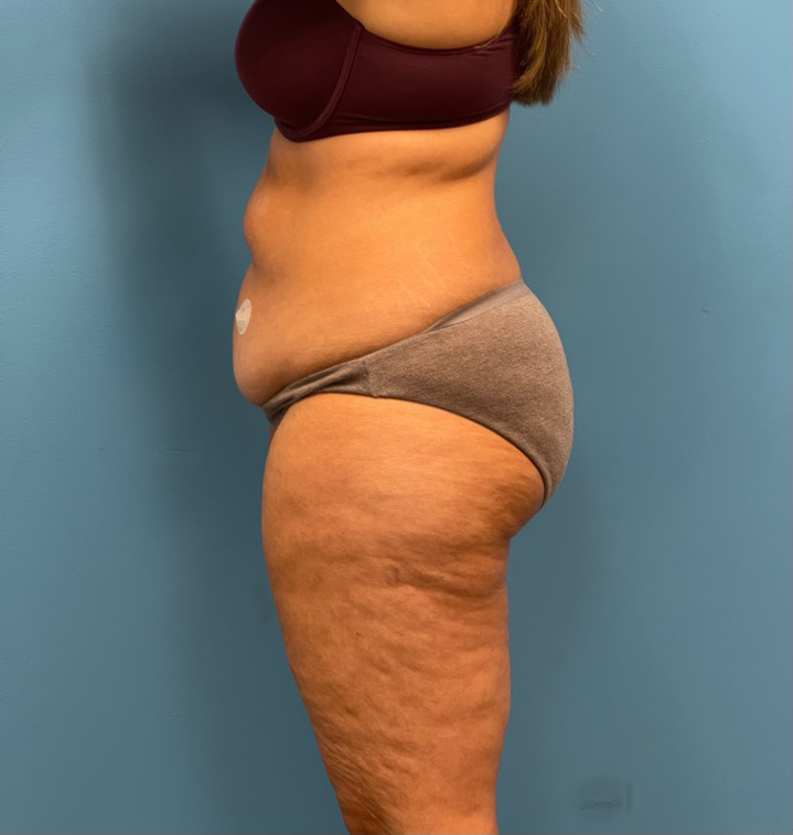 Lipoabdominoplasty-Case--25555 | Before Dr. Samir Rao 2