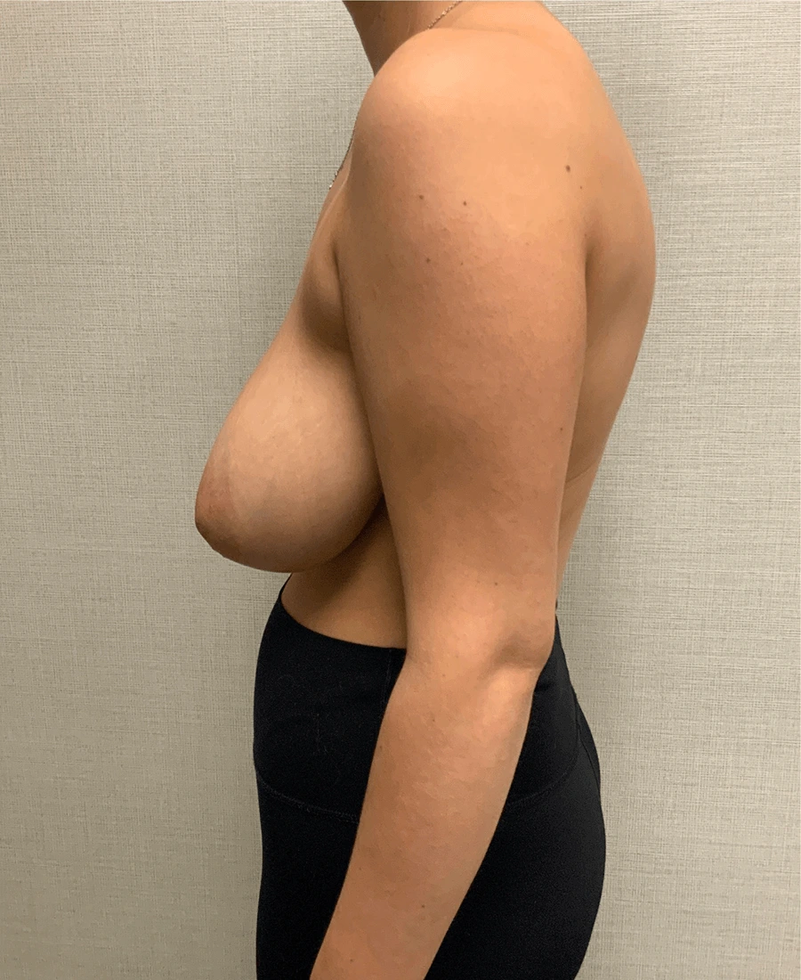 Breast-Reduction-Case--26347 | Before Breast Reduction 3