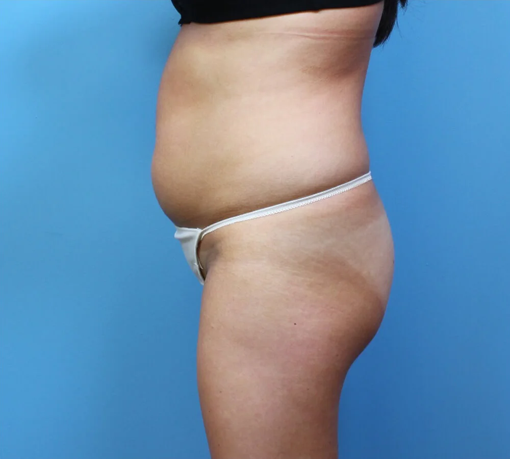 Brazilian-Butt-Lift-Case--265 | Before Body 1