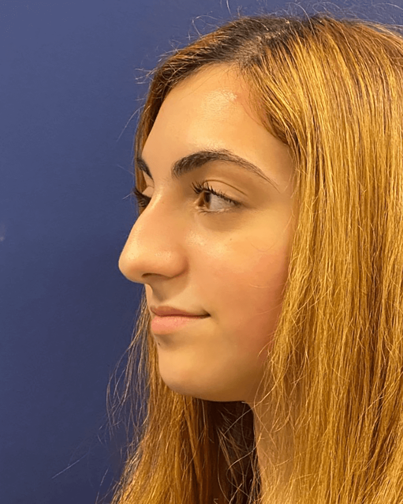 Rhinoplasty-Case--23921 | Before Dr. Arjun Kanuri 2