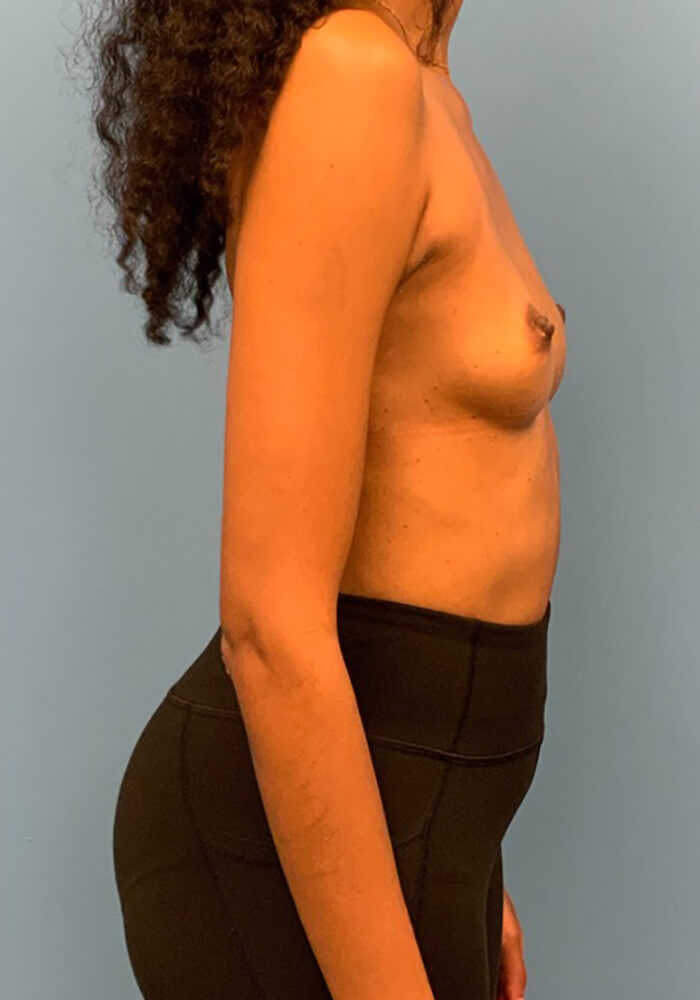 Breast-Augmentation-Case--26022 | Before Dr. Frank Albino 2