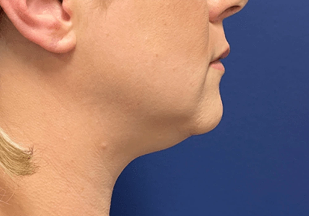 Submental-Liposuction-Case--20811 | Before Face 2