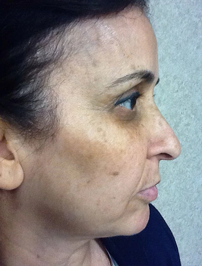 Chemical-Peel-Case--36 | Before Skin Care 3