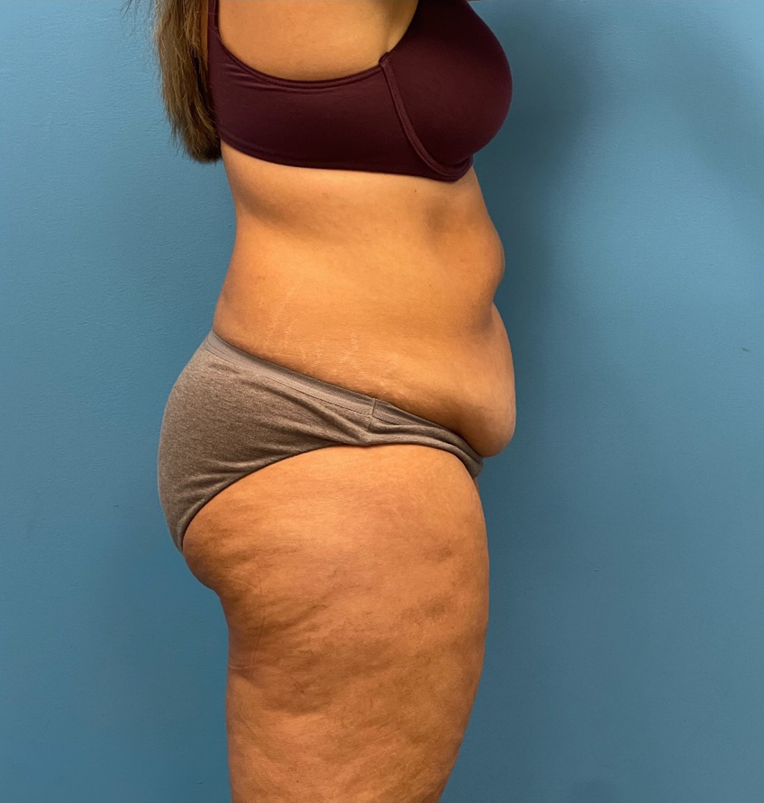 Lipoabdominoplasty-Case--25555 | Before Liposuction 3