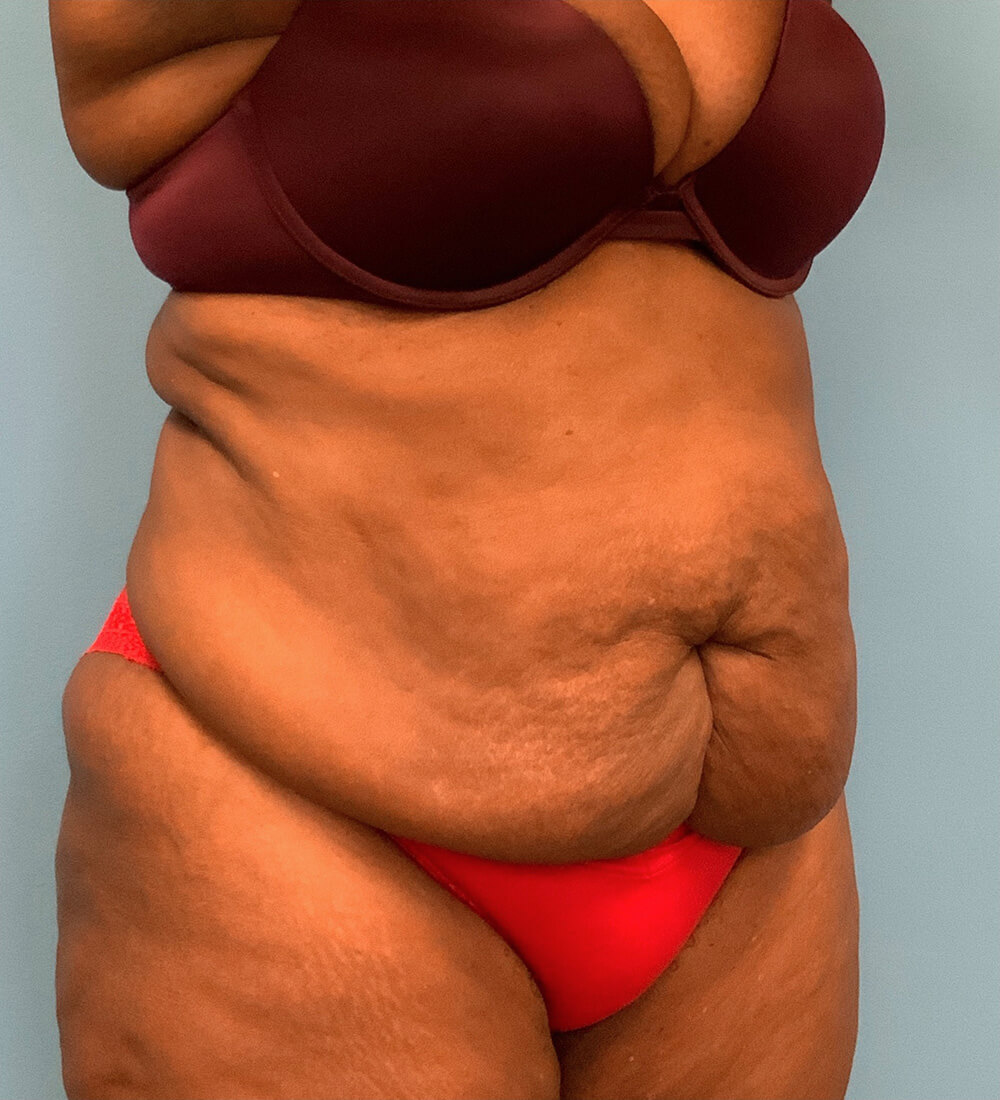 Lipoabdominoplasty-Case--24124 | Before Tummy Tuck 2