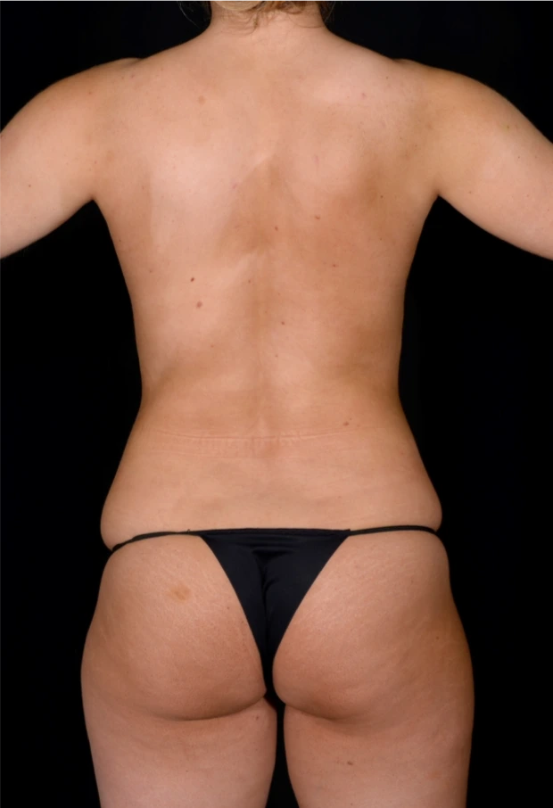 Brazilian-Butt-Lift-Case--5089 | Before Dr. Arjun Kanuri 1