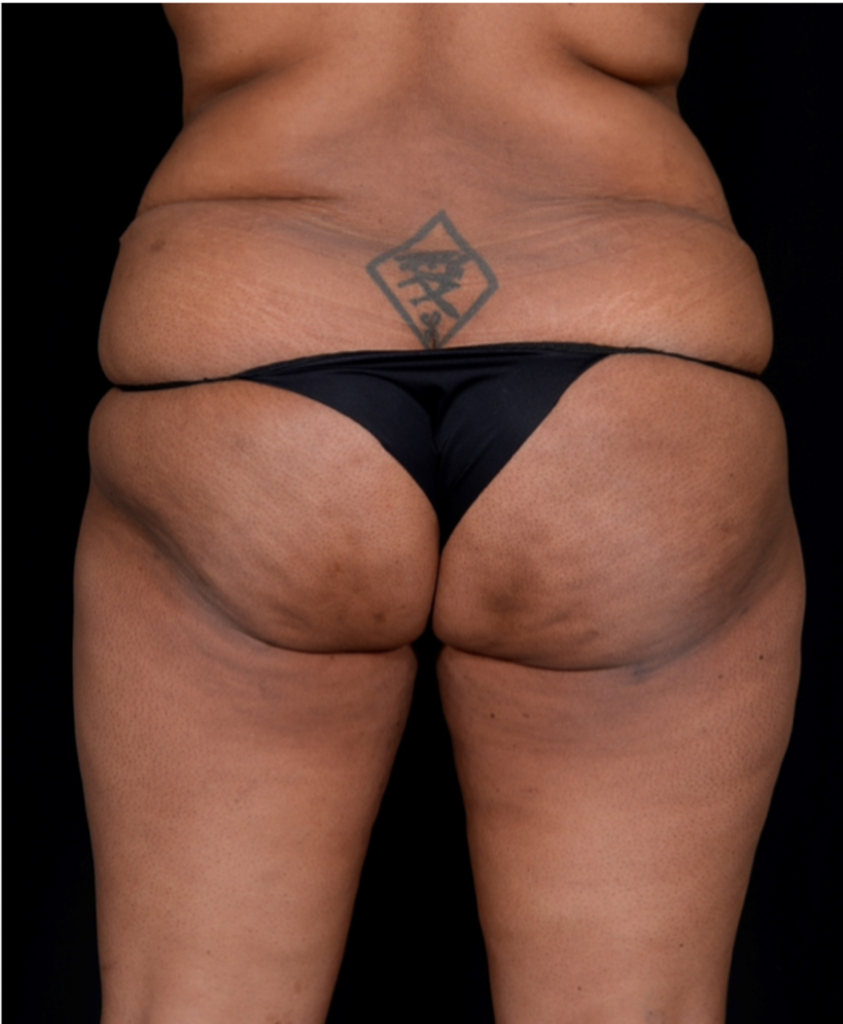 Brazilian-Butt-Lift-Case--7979 | Before Dr. Arjun Kanuri 1