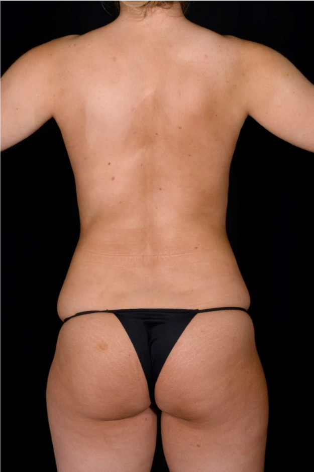 Brazilian-Butt-Lift-Case--5089 | Before Brazilian Butt Lift 9