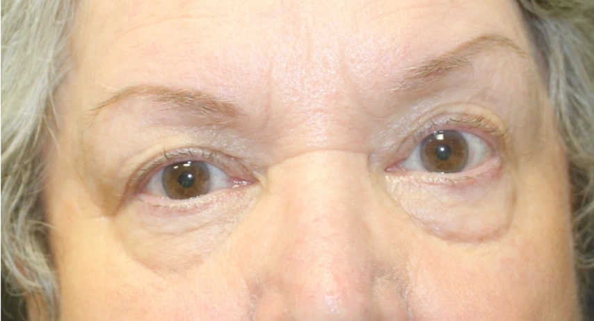 Blepharoplasty-Case--6005 | Before Dr. Arjun Kanuri 1