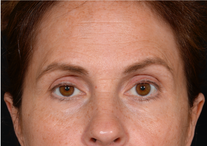 Quad-Blepheroplasty-Case--5361 | Before Eyelid Surgery 1