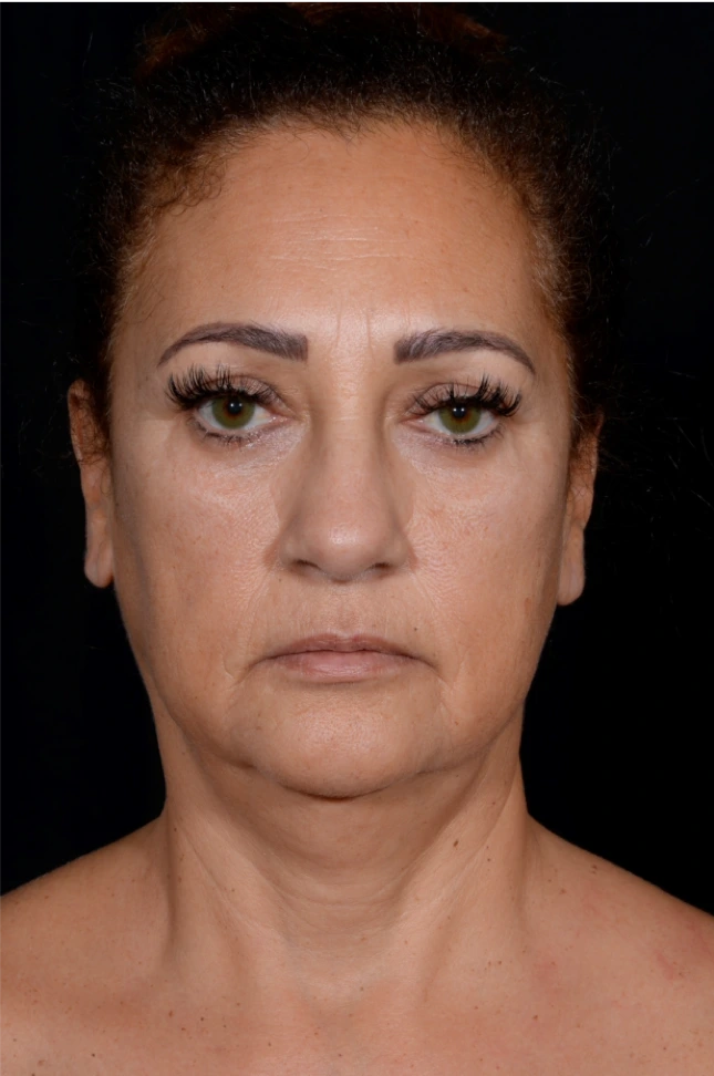 Necklift-Case--4869 | Before Neck Lift 1